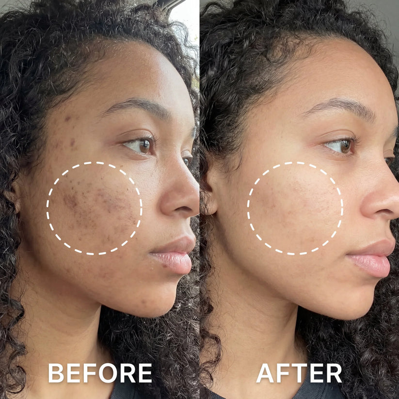 Before and after comparison for dark spots and uneven skin tone