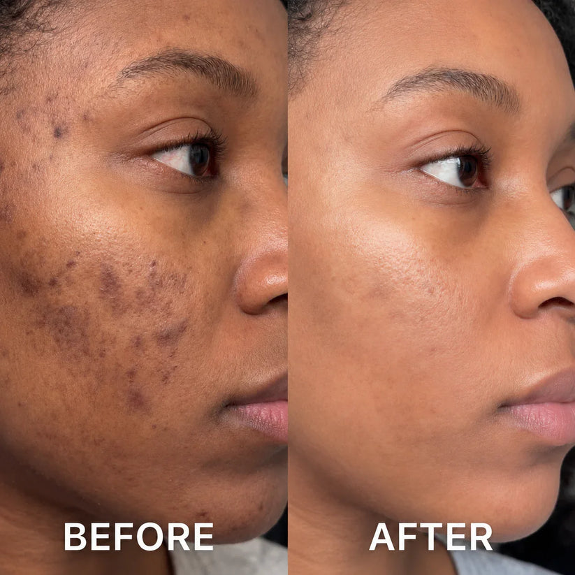 Before and after comparison for acne-prone skin