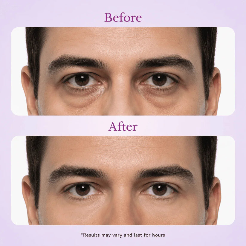 Fempick eye treatment before after
