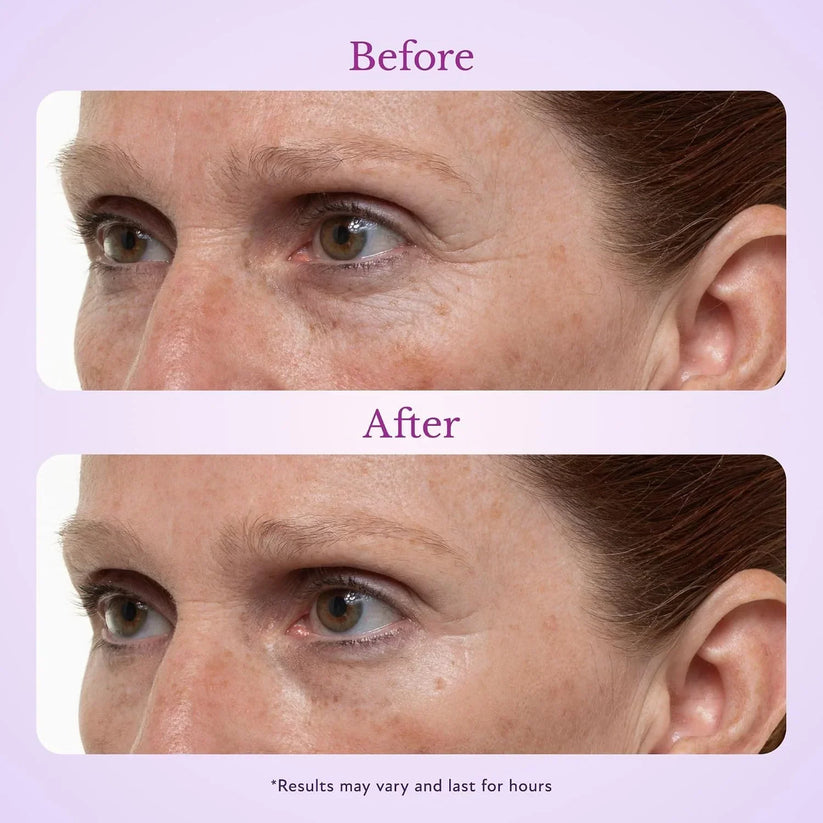 Fempick under eye results