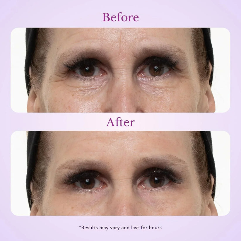 Fempick eye lifting effect