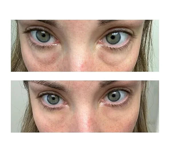 Fempick eye gel customer result image