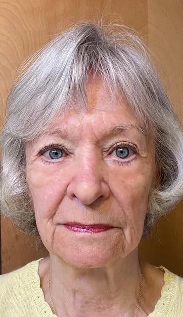 Fempick eye gel application image